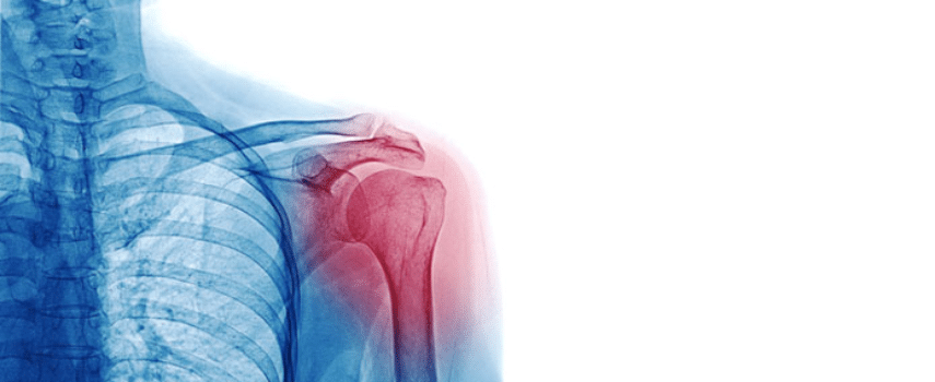 Shoulder injury worker compensation