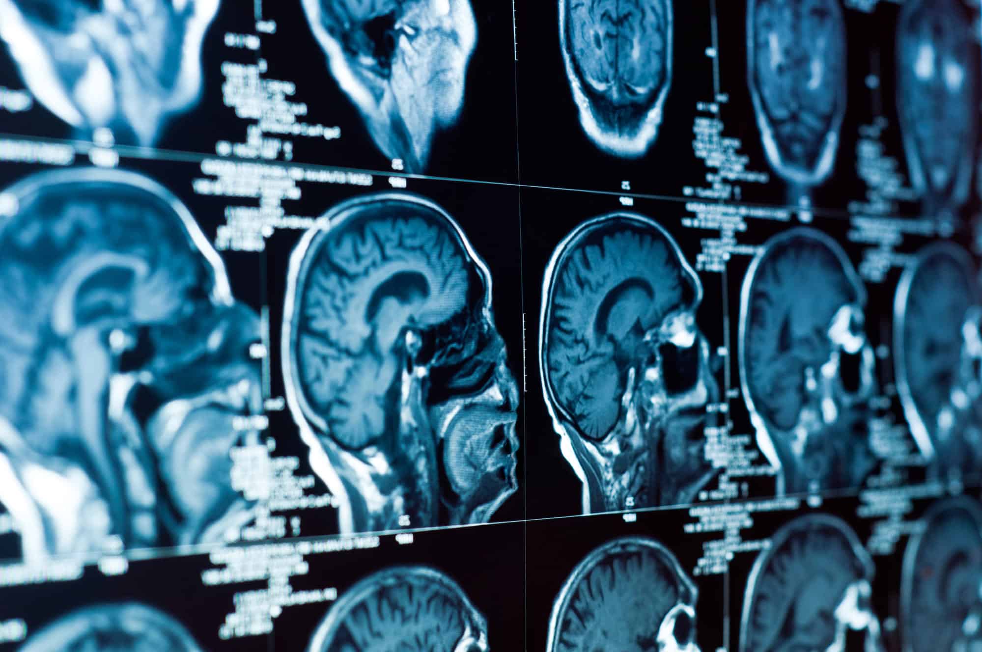 Traumatic Brain Injury due to gravity-related risks such as falling injuries